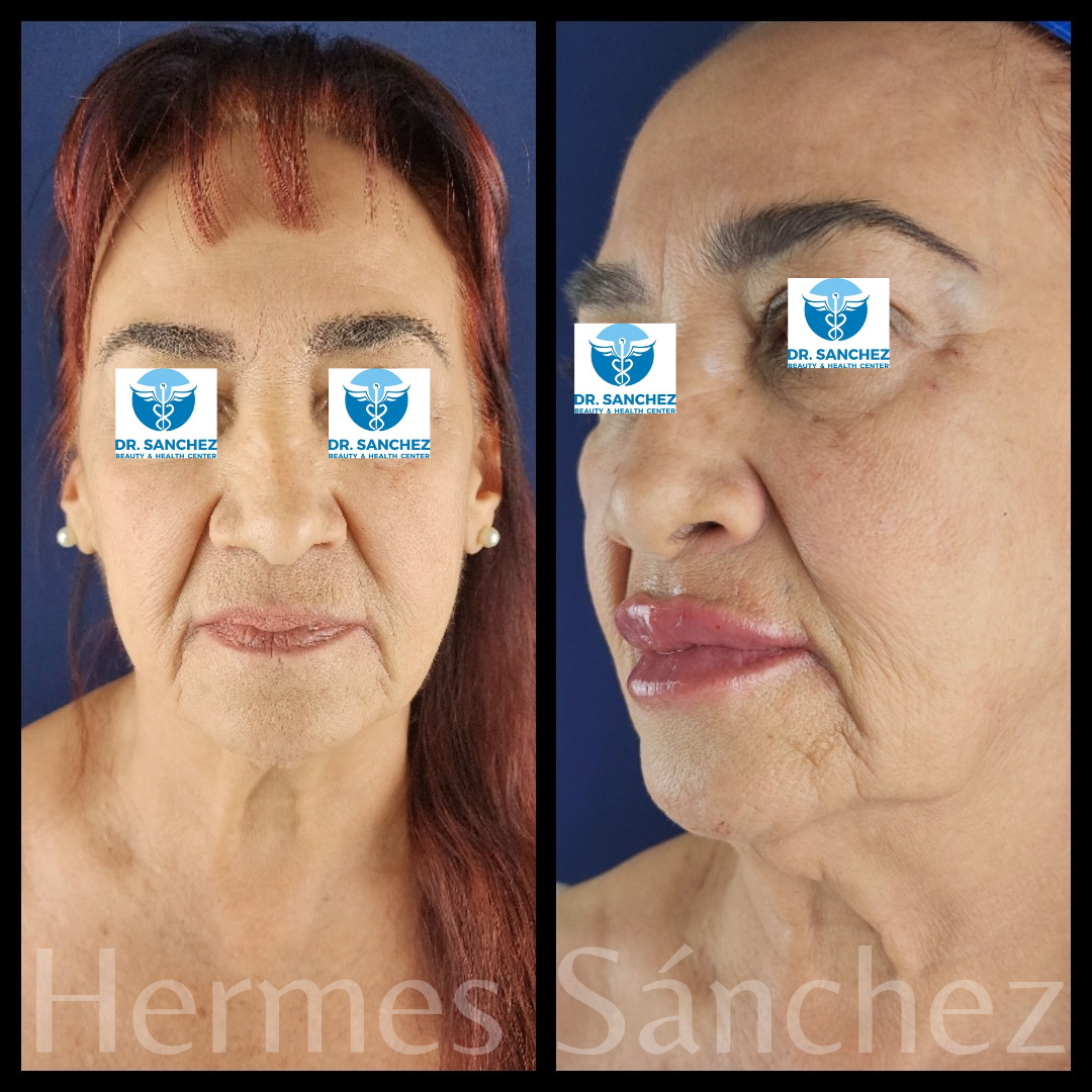 Galería - Transformación 9